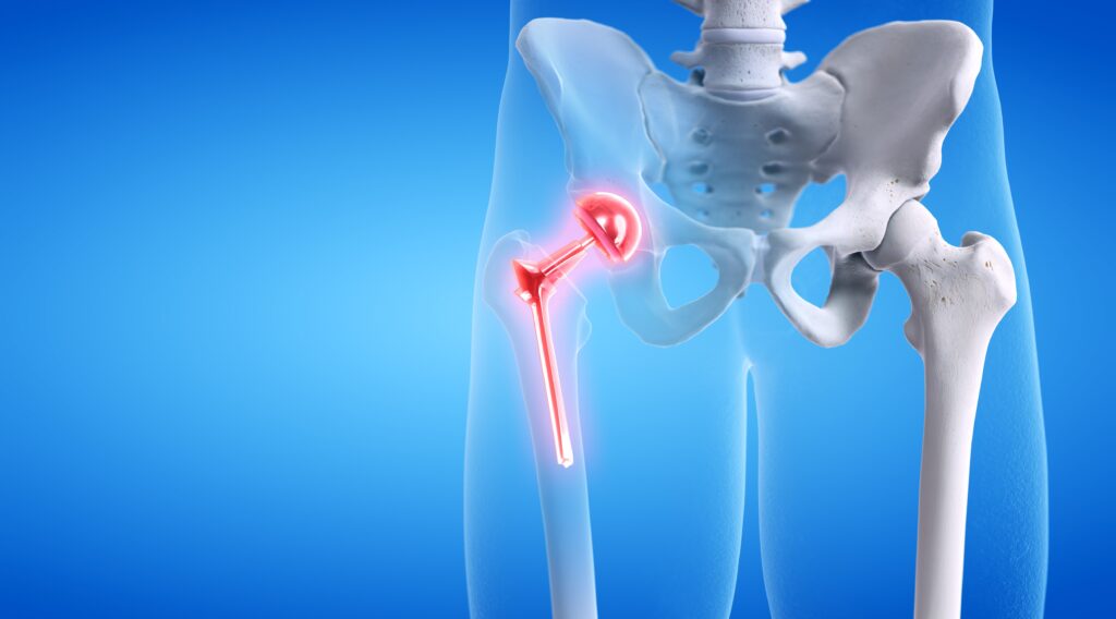 Joint Replacement